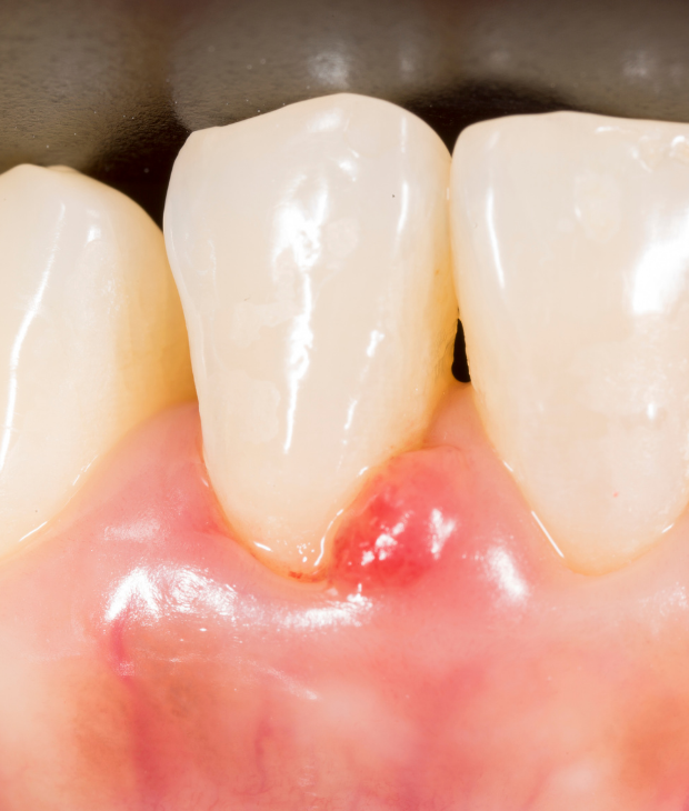 Tratare gingivita dentara parodontologie parodontoza Cabinet Stomatologic Dentar Cluj Napoca Oral Design Clinic