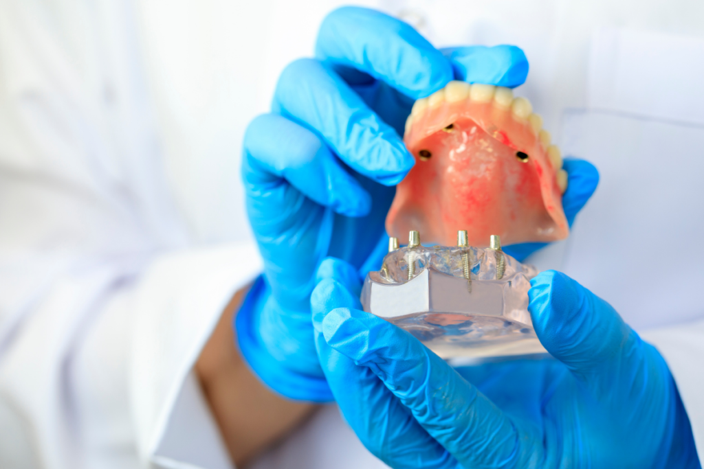 Implant dentar all on 4 all on 6 dinti ficsi in 24 ore Cabinet Stomatologic Cluj Napoca Oral Design Clinic