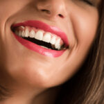 Descoperă avantajele fatetelor dentare pentru un zâmbet perfect. Corectează decolorarea, stricarea și spațiile între dinți cu această soluție populară.